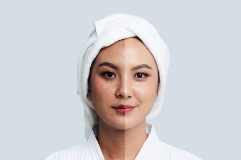 acne facial treatment