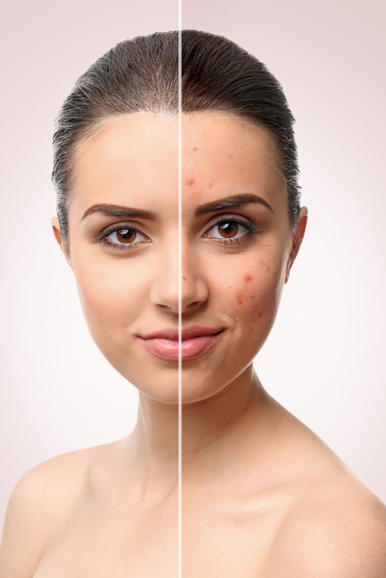 acne face treatment